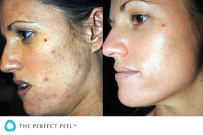 Derma Peel