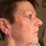 IPL face after one treatment