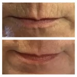 jeuveau, dysport, botox and xeomin can give amazing results
