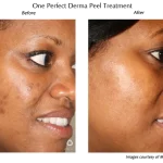 A medical grade chemical peel will do wonders for your skin
