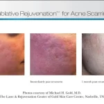 Sublative acne scar improved