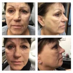 Sculptra can give years back to your look