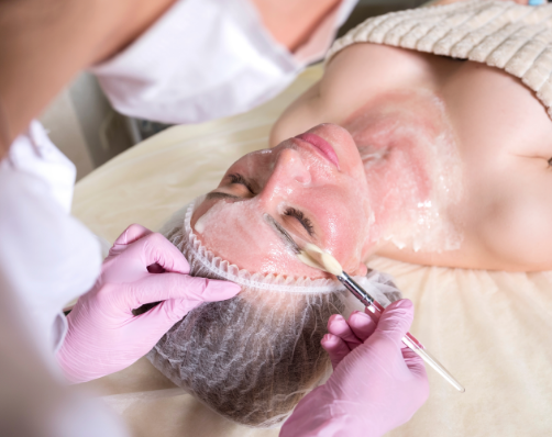 Chemical Peel