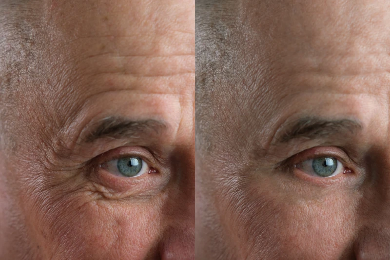 Before and after cosmetic operation. close-up of eyes and forehead of old man, senior with wrinkles on his face
