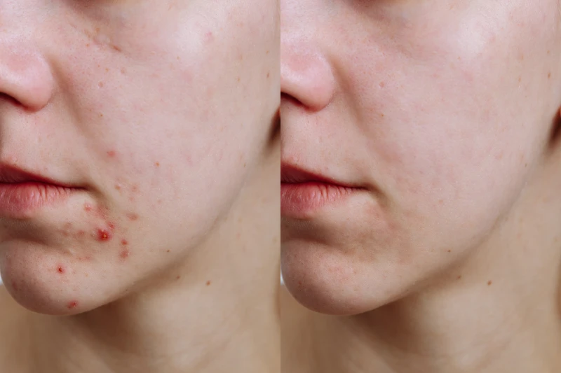 Young woman before and after acne treatment, closeup