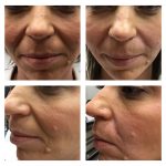 restylane fillers