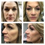 Restylane and dysport