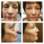 before and after sculptra 12 months